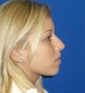 Rhinoplasty