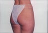 Body Lift
