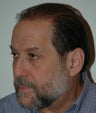 Follicular Unit Hair Transplant