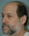 Follicular Unit Hair Transplant