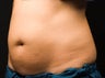 CoolSculpting Procedure with Zeltiq Machine
