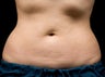CoolSculpting Procedure with Zeltiq Machine