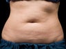 CoolSculpting Procedure with Zeltiq Machine