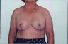 Breast Reduction