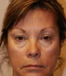blepharoplasty