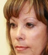 blepharoplasty