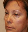 blepharoplasty