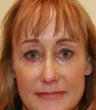 blepharoplasty (eyelids)
