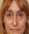 blepharoplasty (eyelids)