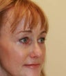 blepharoplasty (eyelids)