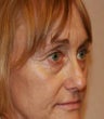 blepharoplasty (eyelids)