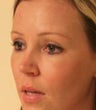 blepharoplasty (eyelids)
