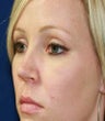 blepharoplasty (eyelids)