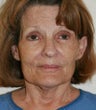 blepharoplasty and laser facial treatment