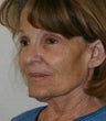 blepharoplasty (eyelids)