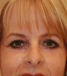 blepharoplasty (eyelids)