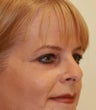 blepharoplasty (eyelids)