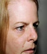 blepharoplasty (eyelids)