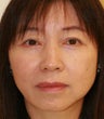 blepharoplasty (eyelids)