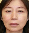 blepharoplasty (eyelids)