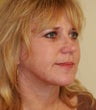 blepharoplasty (eyelids)