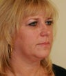 blepharoplasty (eyelids)
