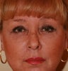 blepharoplasty (eyelids)