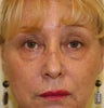 blepharoplasty (eyelids)