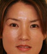 blepharoplasty (eyelids)