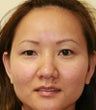 blepharoplasty (eyelids)