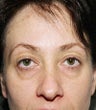blepharoplasty (eyelids)