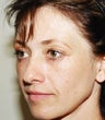 blepharoplasty (eyelids)