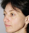 blepharoplasty (eyelids)