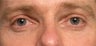 Restylane upper eyelid hollows
