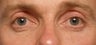 Restylane upper eyelid hollows