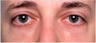 Restylane to lower eyelid hollows