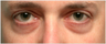 Restylane to lower eyelid hollows