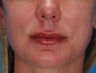 Lip Augmentation with Juvederm