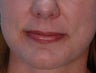 Lip Augmentation with Juvederm