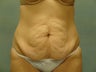 Tummy Tuck