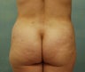Brazillian Butt lift
