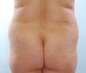 Brazillian Butt lift
