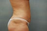 Liposuction