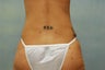 Liposuction