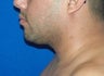 Laser Liposuction