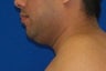 Laser Liposuction