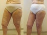 Circumferential thigh lift