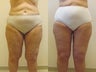 Circumferential thigh lift