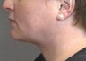 VASER® Lipo:  Neck