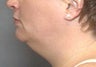 VASER® Lipo:  Neck